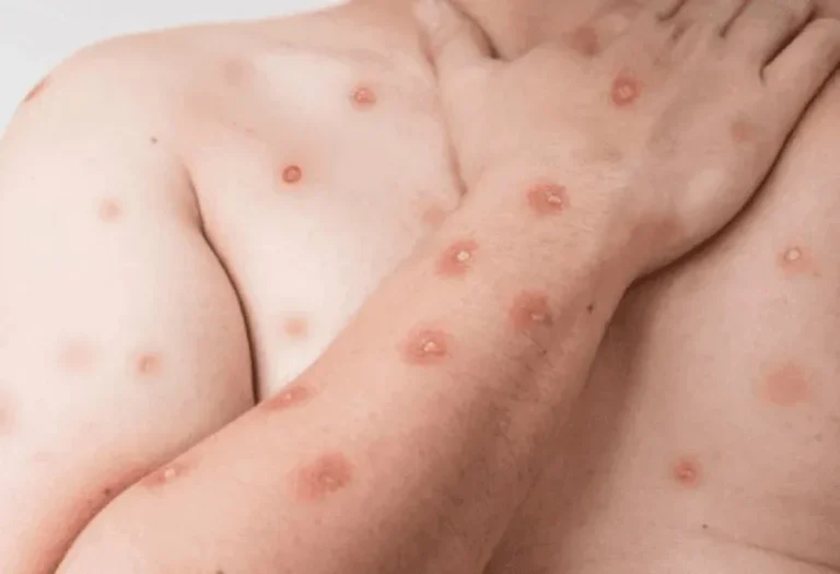Risco  de novo surto de Mpox não é descartado no Brasil, casos são registrados nos estados